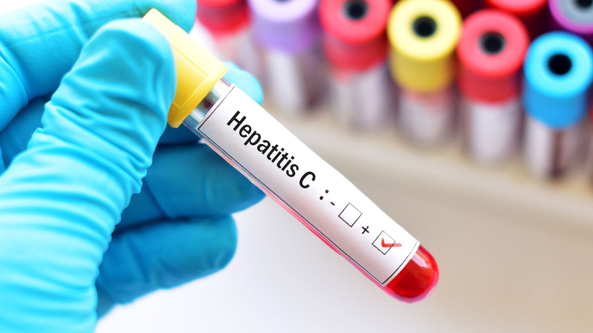 hepatita C sursa foto doc.ro