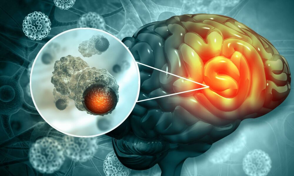 Cancerul cerebral, cauzat sau nu de telefonul mobil? Anunțul OMS